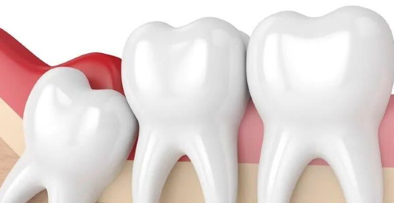 Usuwanie ósemek - jak wygląda?